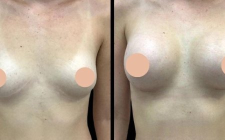 Breast Augmentation Surgery in Dubai for Expats: What You Need to Know