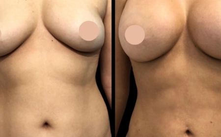 Enhancing Natural Beauty: Breast Augmentation Surgery in Dubai