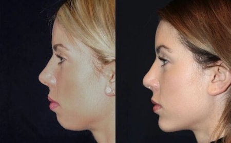 Best Doctors in dubai for Chin Fillers: Safe, Effective, and Quick Results