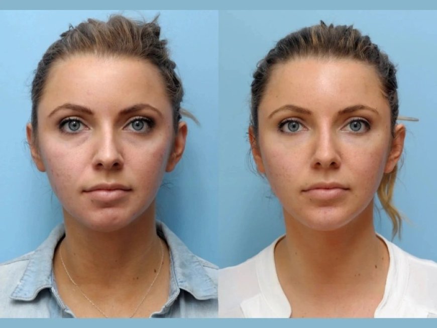 Thread Lift in Dubai for Eyebrow Lifting: What You Should Know