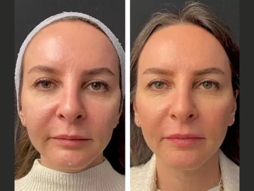 Why the Best Plastic Surgeons in Dubai Recommend Mesotherapy for Under-Eye Circles
