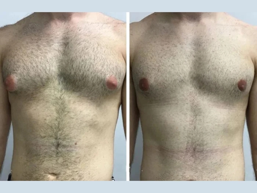 Can Teenagers Undergo Gynecomastia Surgery in Dubai? Age and Consent Rules