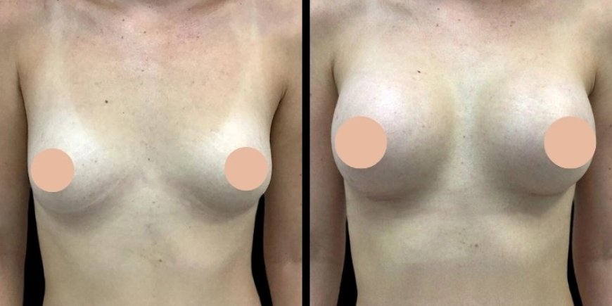 Breast Augmentation Surgery in Dubai for Expats: What You Need to Know