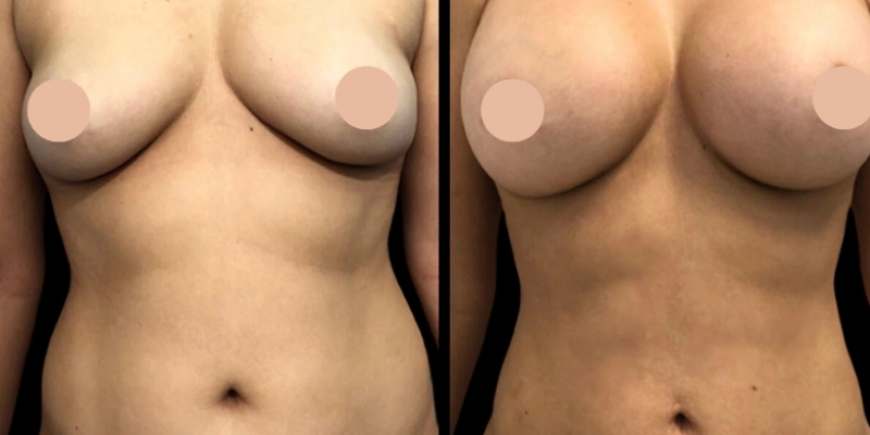 Enhancing Natural Beauty: Breast Augmentation Surgery in Dubai