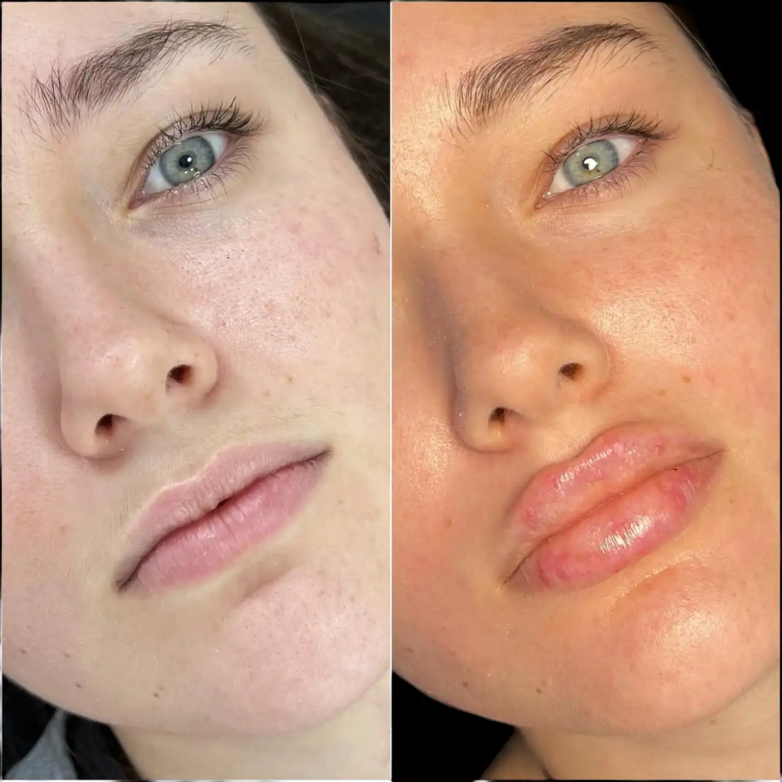Why People Trust the Best Doctors in Dubai for Fillers