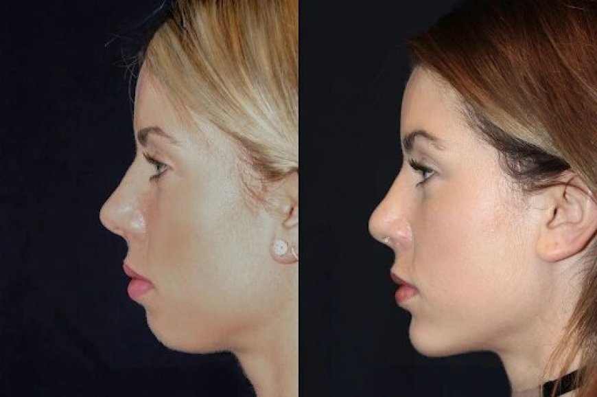 Best Doctors in dubai for Chin Fillers: Safe, Effective, and Quick Results