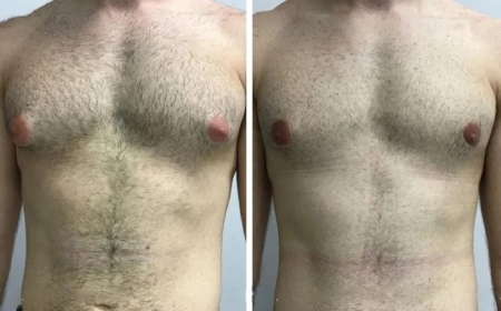 Patient Reviews: Choosing the Best Gynecomastia Surgeon in Dubai