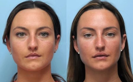 Trusted Clinics with the Best Doctors in Dubai for Thread Lift