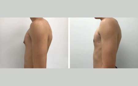 The Role of Post-Op Care in Achieving the Best Results from Your Gynecomastia Surgery in Dubai