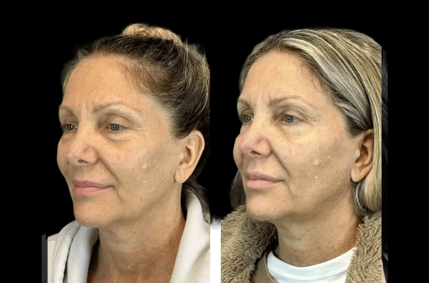 Minimal Downtime Botox Treatments from the Best Aesthetic Clinics in dubai