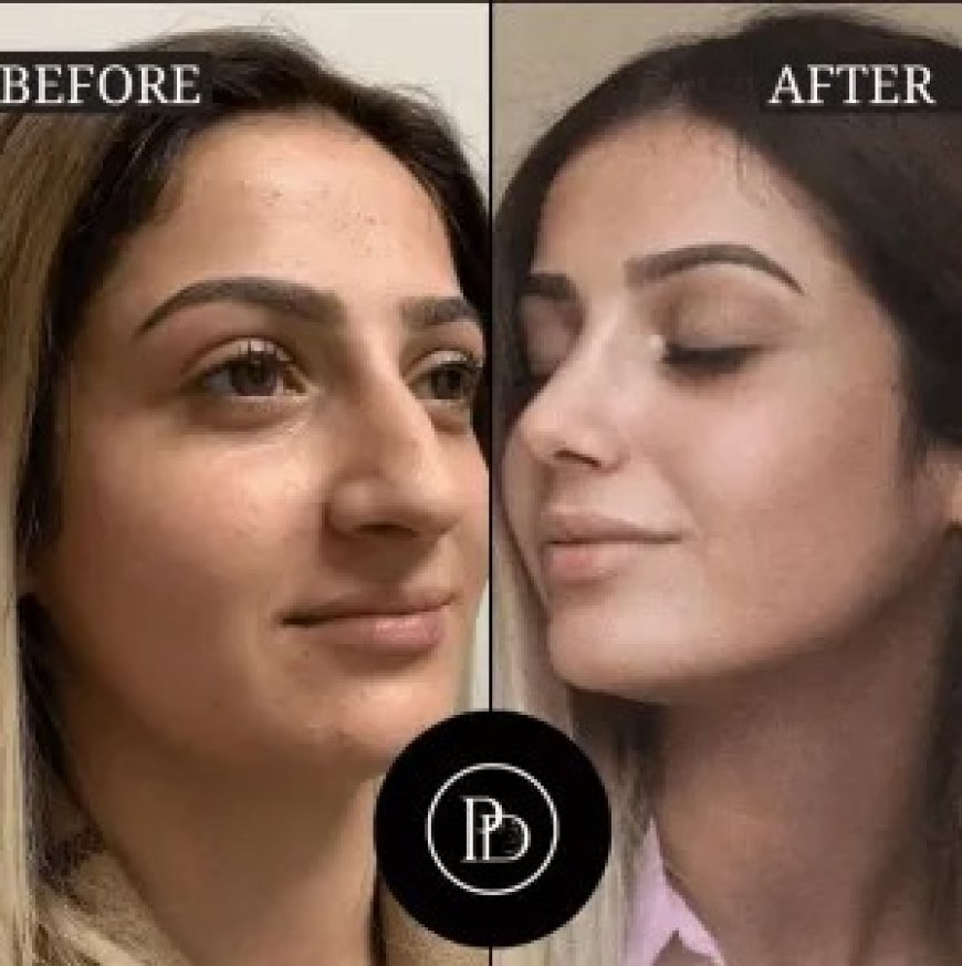 From Celebrities to Locals: Why Everyone Loves PRP Treatment in Dubai