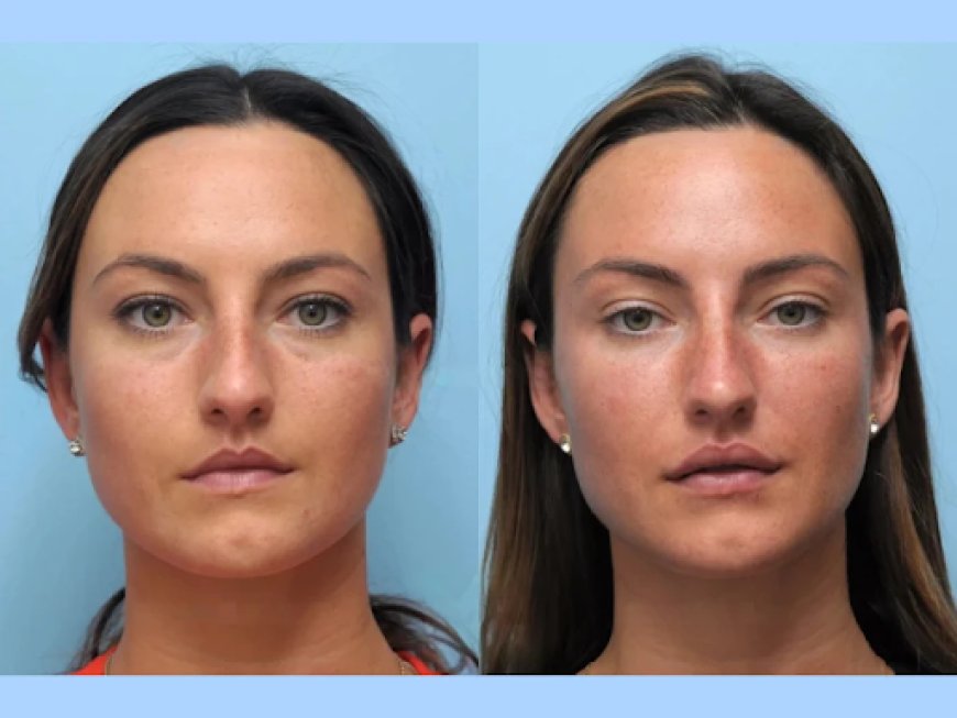 Trusted Clinics with the Best Doctors in Dubai for Thread Lift