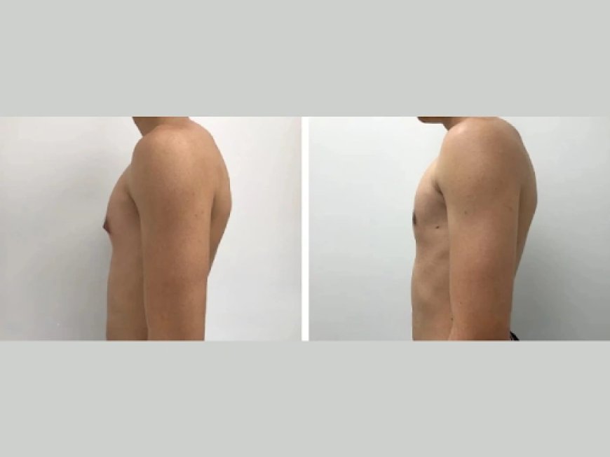 The Role of Post-Op Care in Achieving the Best Results from Your Gynecomastia Surgery in Dubai